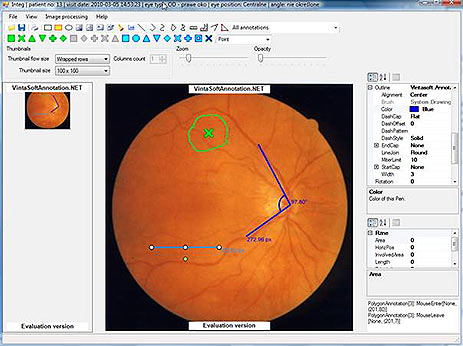 Diabetic Retinopathy Screening Module. Annotations of the lesions.